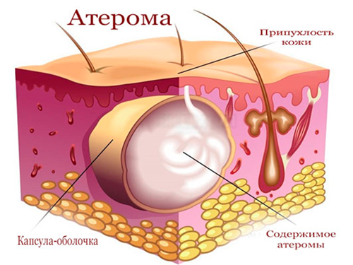 Атерома или киста сальной железы