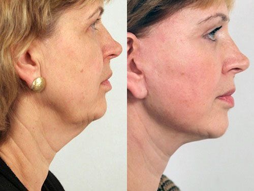 Подтяжка шеи или платизмопластика фото до и после
