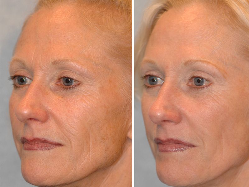 Микротоки для лица фото до и после