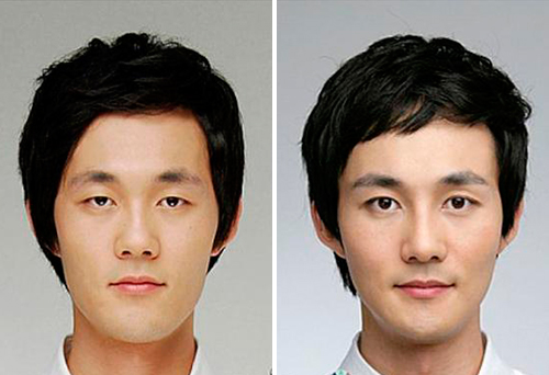 Операция блефаропластики азиатских век фото до и после