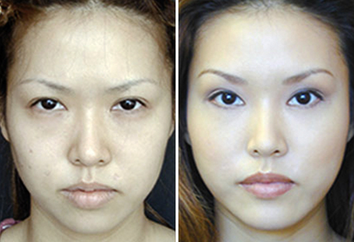 Блефаропластика азиатских глаз фото до и после