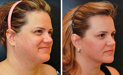 Фото до и после ментопластики