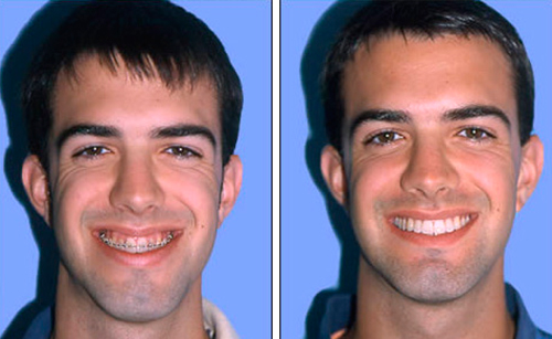 Фото до и после ментопластики
