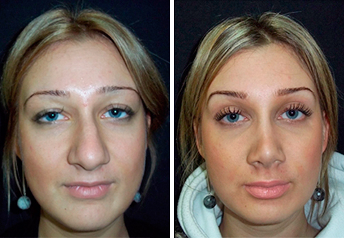 Хирургическая пластика носа, фото до и после