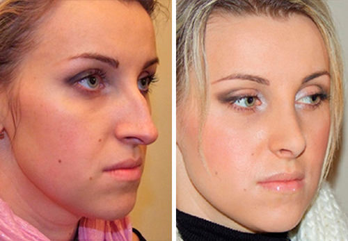 Пластика носа , фото до и после