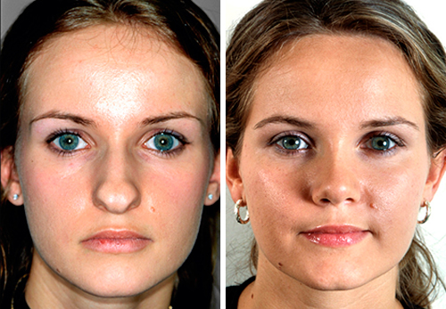 Хирургическая пластика ринопластика носа, фото до и после