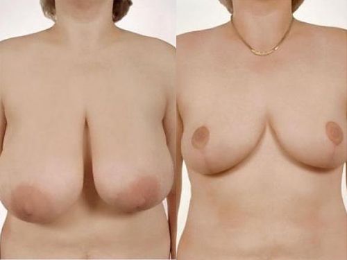 Результат коррекции формы сосков при уменьшении груди