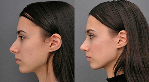 Безоперационная коррекция формы носа фото до и после
