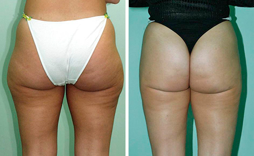 Липомоделирование тела: фото до и после операции