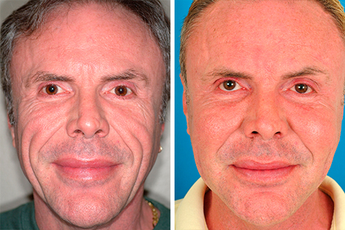 Миостимуляция лица фото до и после