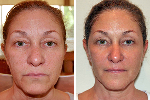 Миостимуляция лица фото до и после процедуры