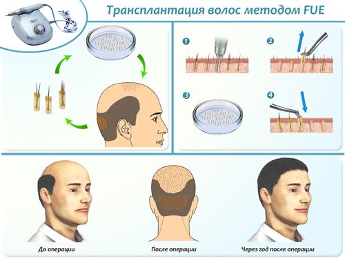 Пересадка волос бесшовным методом FUE