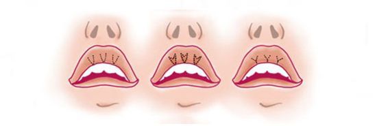 V-Y техника коррекции губ