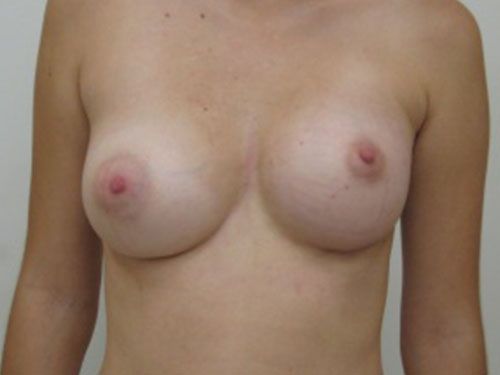 Асимметрия груди после увеличивающей маммопластики