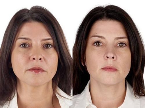 Эффект плазмотерапии лица фото до и после процедуры