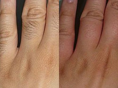 Электроэпиляция пальцев рук фото до и после
