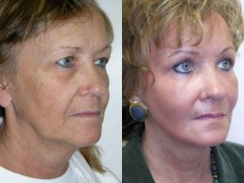 Эндоскопическая подтяжка лица фото до операции и после