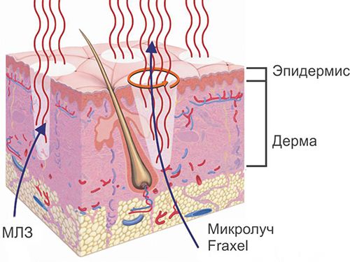 Процесс воздействия на кожу эрбиевым лазером
