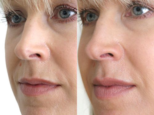 Гликолевый пилинг лица фото до и после процедуры