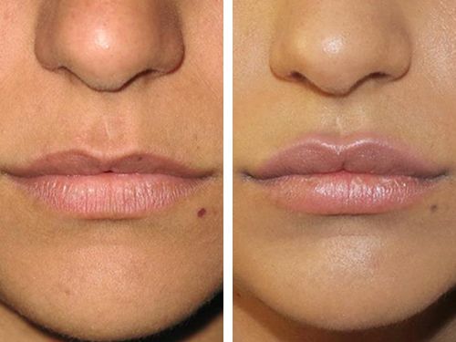 Пластика губ или хейлопластика фото до и после