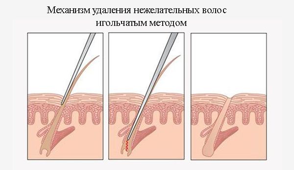 Механизм удаления нежелательных волос игольчатым методом
