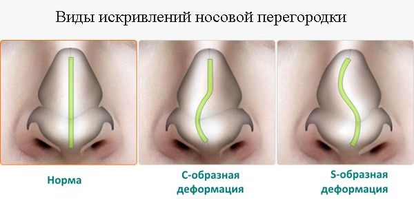 Основные виды искривлений носовой перегородки