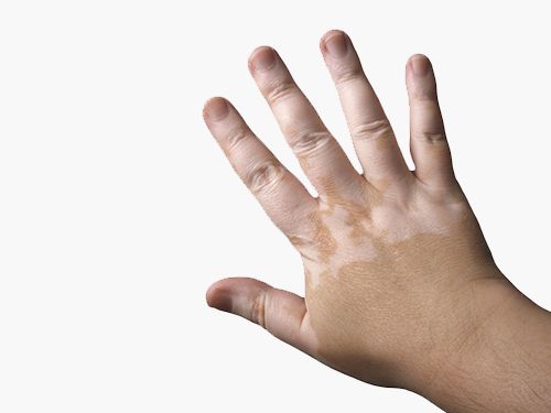 Как лечить заболевание кожи витилиго?