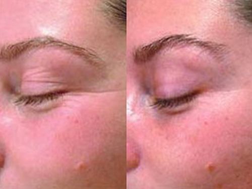 Карбокситерапия для омоложения кожи фото до и после