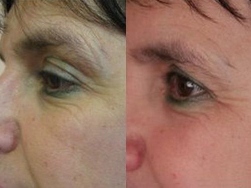 Омоложение кожи в коллагенарии фото до и после процедуры
