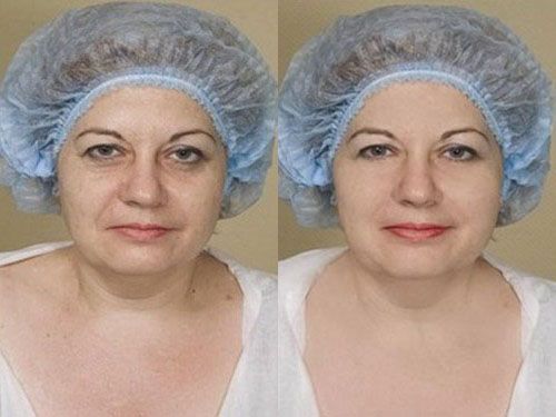 Результаты коллостотерапии фото до и после