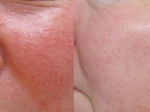 Лечение купероза на лице фото до и после