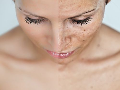 Методы лечения пигментных пятен на лице