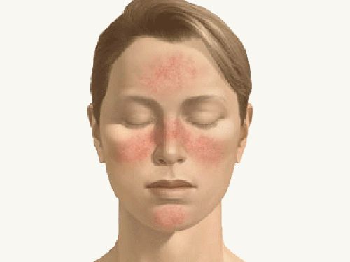 Лечение розацеа или розовых угрей на лице