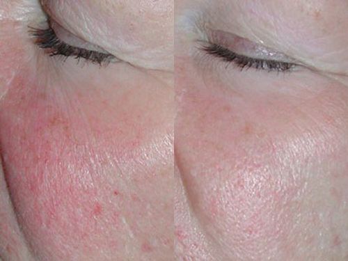 Лечение розацеа на лице фото до и после
