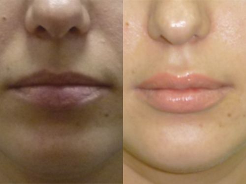 Липофилинг губ фото до и после процедуры