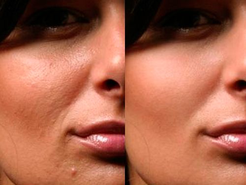 Эффект после ультразвуковой чистки лица фото до и после
