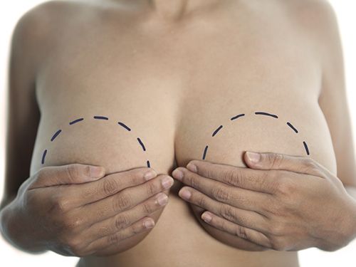 Редукционная маммопластика или уменьшение размера груди