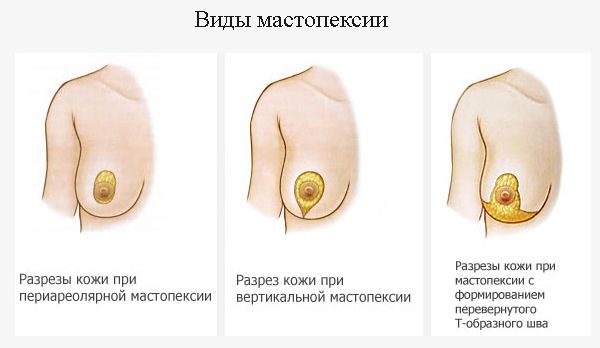 Виды мастопексии или хирургической подтяжки груди