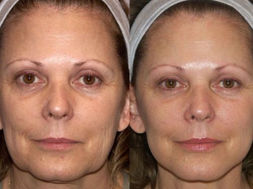 Мезонити для лица фото до и после проведения процедуры