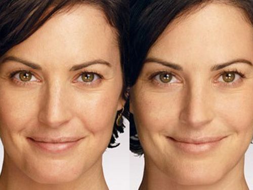 Мезотерапия лица фото до и после