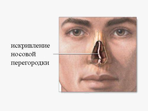 Особенности операции по исправлению носовой перегородки