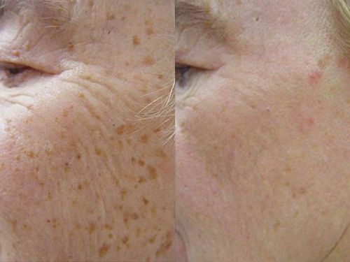 Пигментные пятна на лице фото до лечения и после
