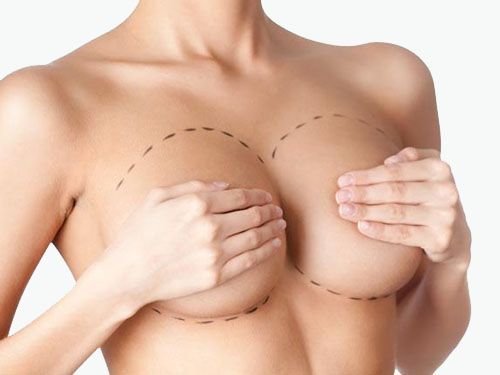 Причины реэндопротезирования груди