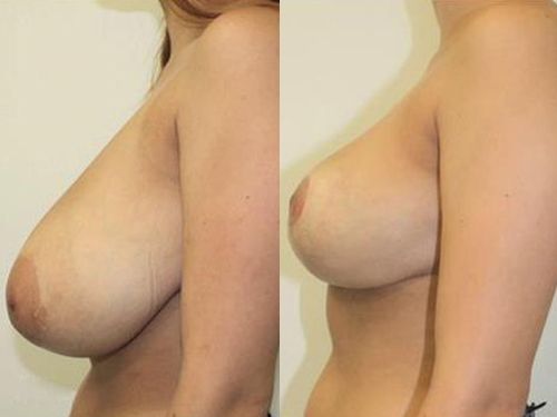 Результаты уменьшения груди или редукционной маммопластики