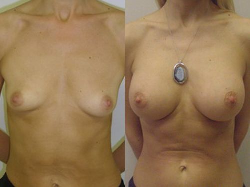 Увеличивающая маммопластика фото до и после
