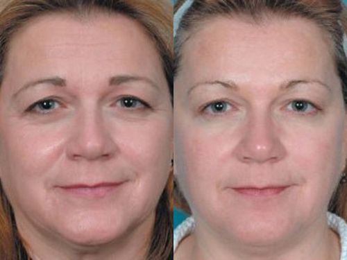 Эффект плазмотерапии лица фото до и после процедуры