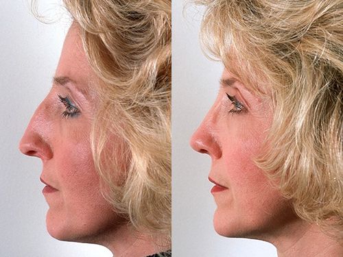 Резуьтаты пластики носа фото до и после операции