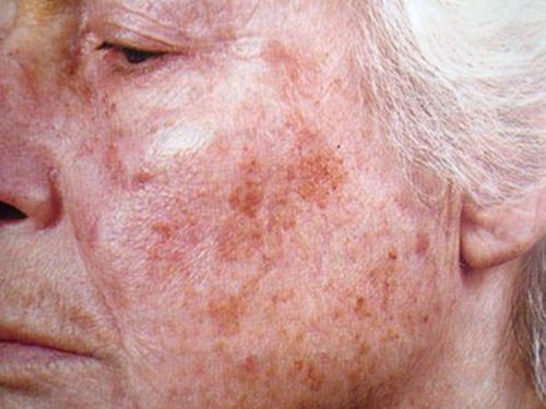 Старческая или возрастная пигментация кожи
