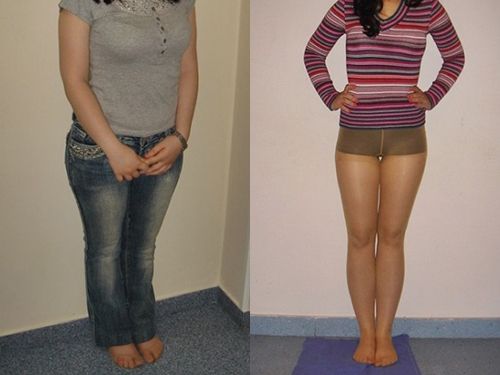 Удлинение ног фото до и после хирургического вмешательства