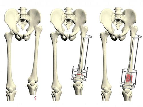 Методики удлинения ног хирургическим путем
